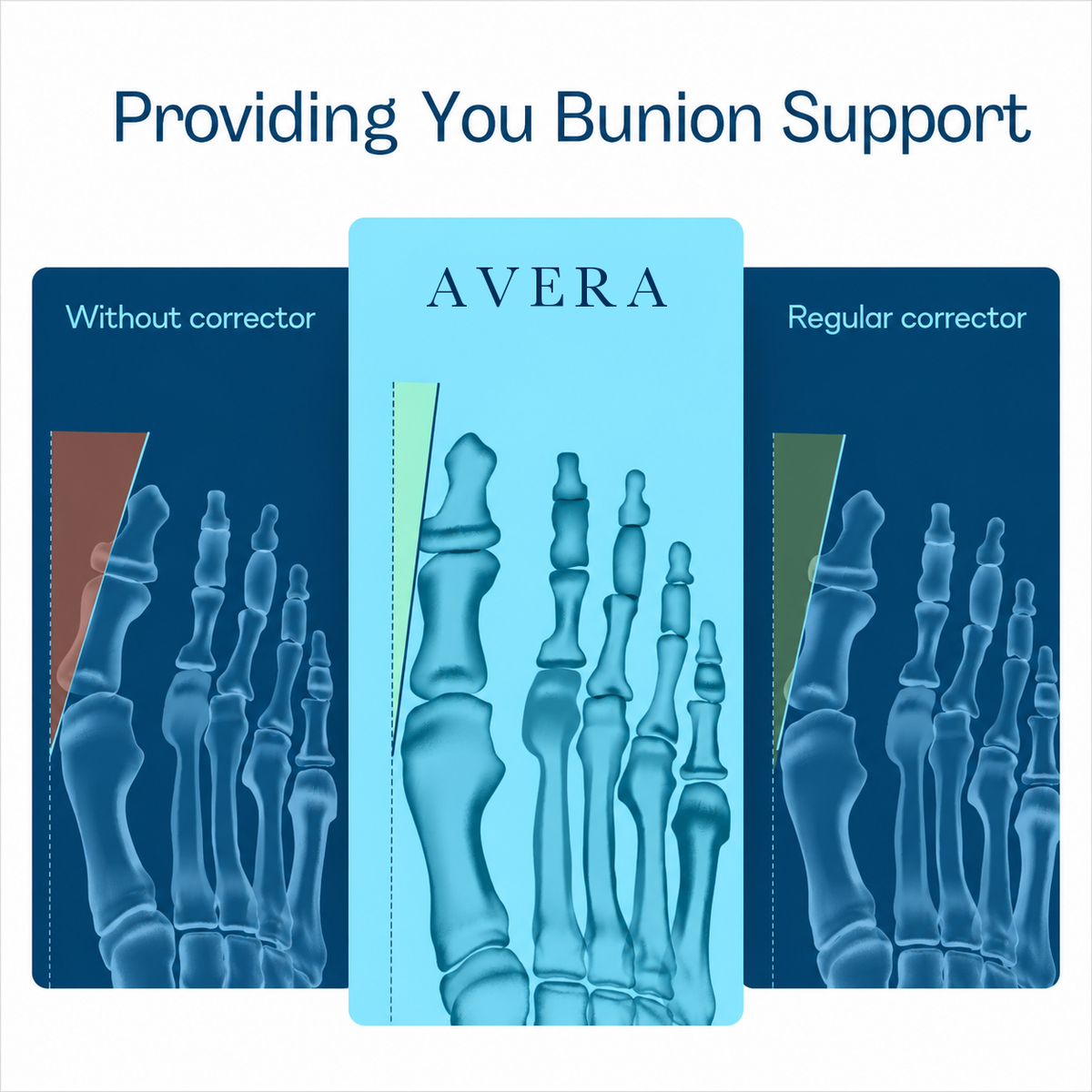Avera Paris™ EMS Bunion Fix